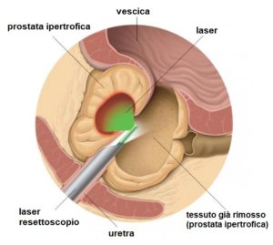 Patologia prostatica